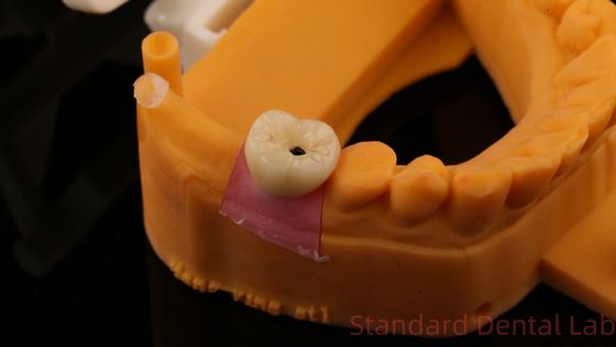 Купить Зубные имплантаты винт удержанная корона PFZ фарфоровый слоистый циркония с 3D-печати модели онлайн изготовление