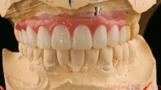 Купить Хорошее покрытие Эстетическая циркония Порцелановая корона Розовая Порцела с отбеливающим оттенком онлайн изготовление