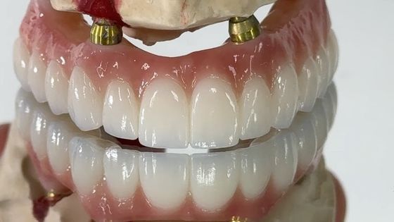 Стоматологический имплантат PFM Crown Titanium фиксированный гибридный протез
