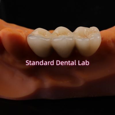 Цифровая CAD CAM стоматологическая лаборатория короны Прозрачные слоистые циркониевые короны