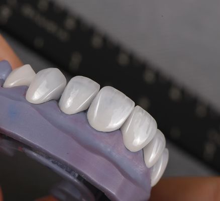 Естественный вид Emax Veneers Crown Biocompatibility Bleaching Shade с минимальной подготовкой