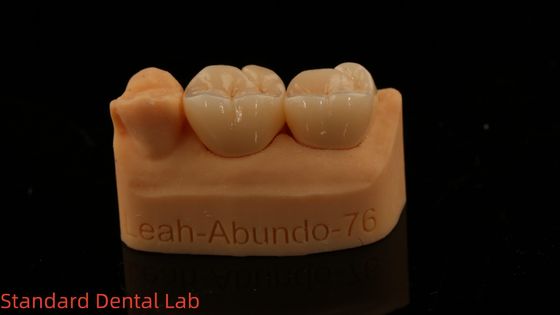 Твердые стоматологические короны 3D Pro высокопрозрачные короны из цирконии с 5-летней гарантией