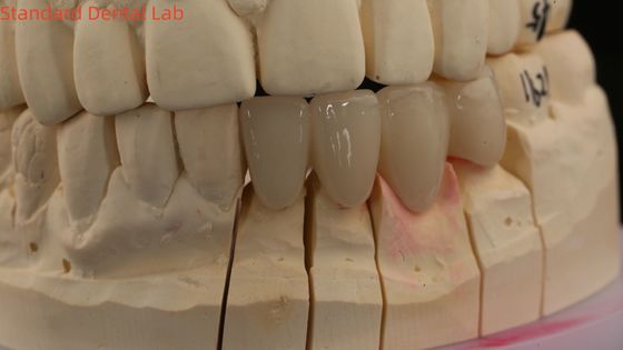 Твердые зубные короны 3D Pro высокопрозрачные полные циркониевые короны с витовым оттенком