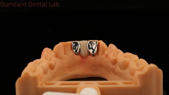 Стоматологическая PFM Maryland Bridge Высокая эстетика FDA сертифицирована с Vita Porcelian China Dental Lab