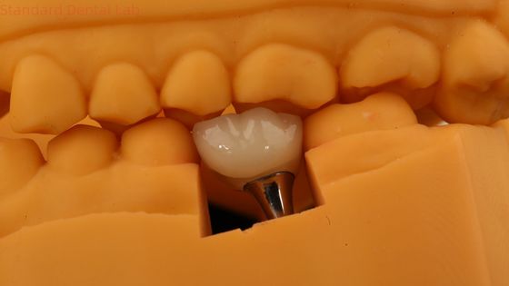 Шрубовые зубные имплантаты короны зубной PFM короны с 3D-печатью модели