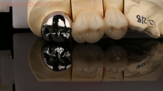 Полнометаллическая корона из порцеляна Вита с ядром 3 года гарантия от стоматологической лаборатории