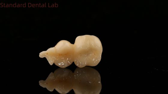 Стоматологическая цифровая цирконовая корона с 3D-печатью SDL Dental Lab Zirconia Onlay
