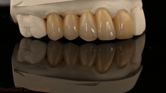 Норитаке Порцеляновый полный контур Циркониевая корона высокая эстетика Естественный индивидуальный Циркониевый зубной мост
